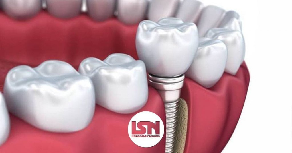 ilha-solteira-news-gou-odonto-implante-dentario