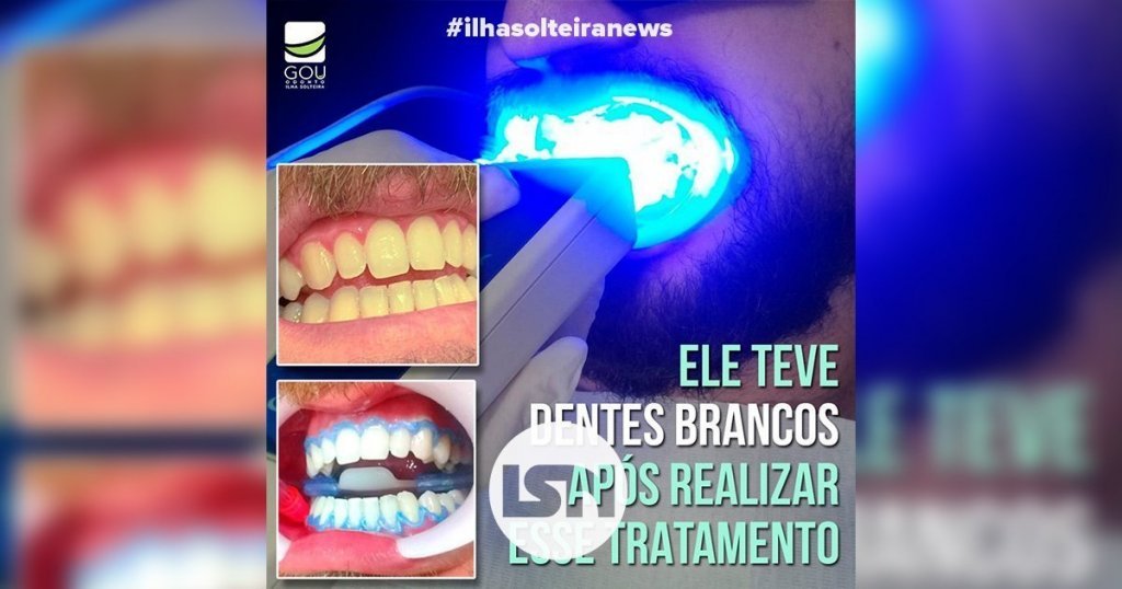 clareamento-bmw-gou-odonto-ilha-solteira-news-isn