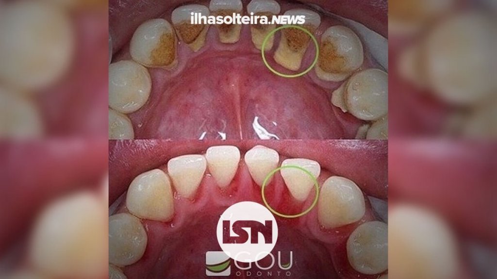 tartaro-gou-odonto-ilha-solteira-news