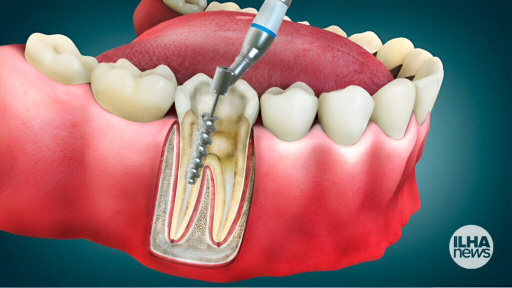 Valdir Mototáxi propõe que Prefeitura de Ilha Solteira ofereça tratamento de canal 2 ilha-news-endodontia-tratamento-de-canal-centro-odontologico-de-ilha-solteira