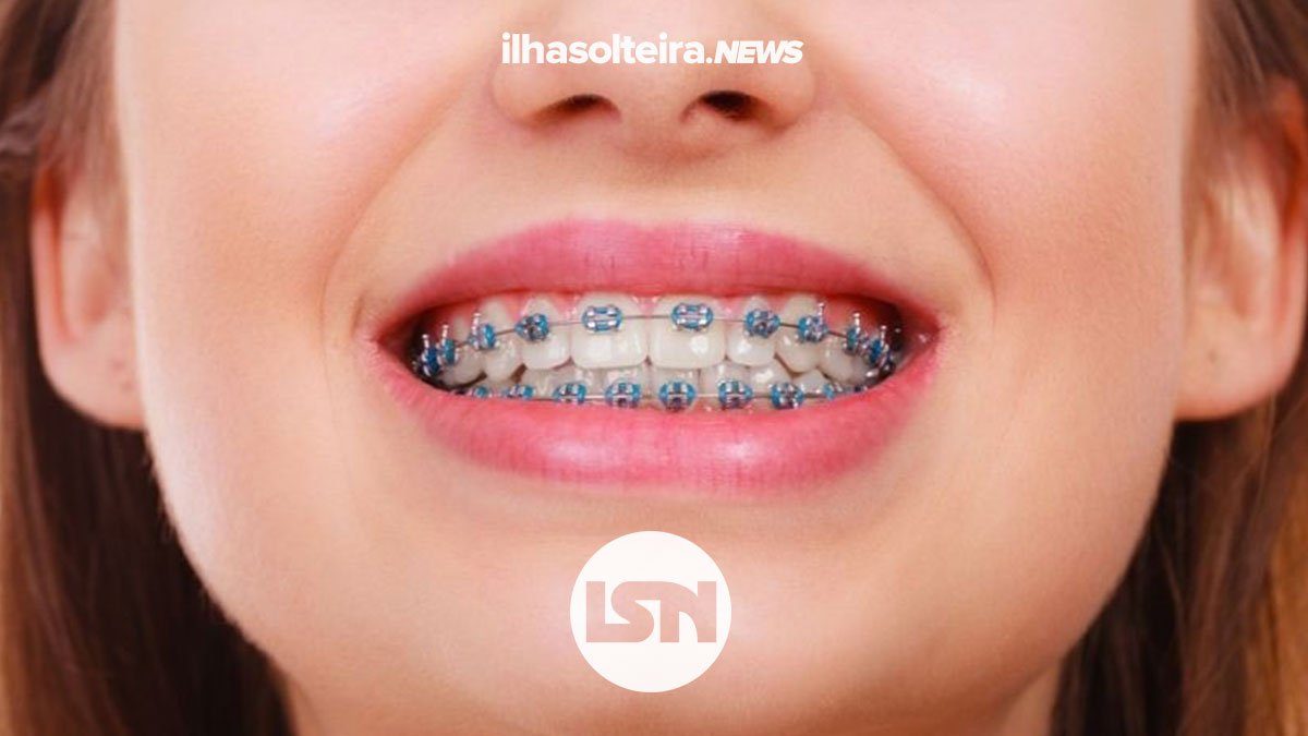 aparelho-fixo-ortodontia-gou-odonto-ilha-solteira-news
