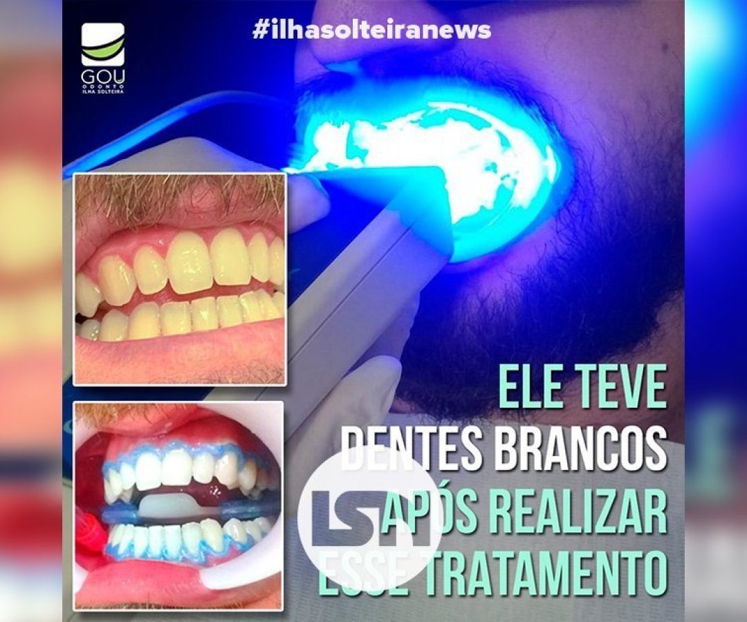 clareamento-bmw-gou-odonto-ilha-solteira-news-isn clareamento-bmw-gou-odonto-ilha-solteira-news-isn