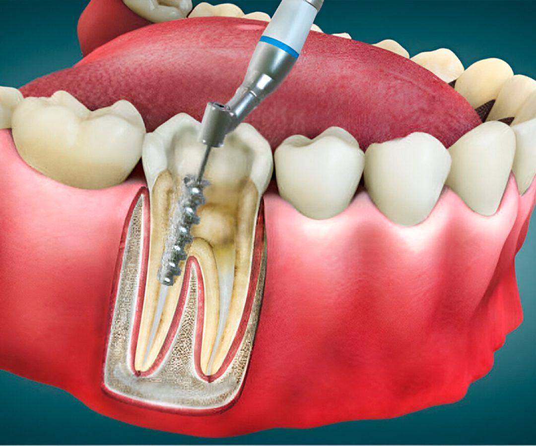 ilha-news-endodontia-tratamento-de-canal-centro-odontologico-de-ilha-solteira