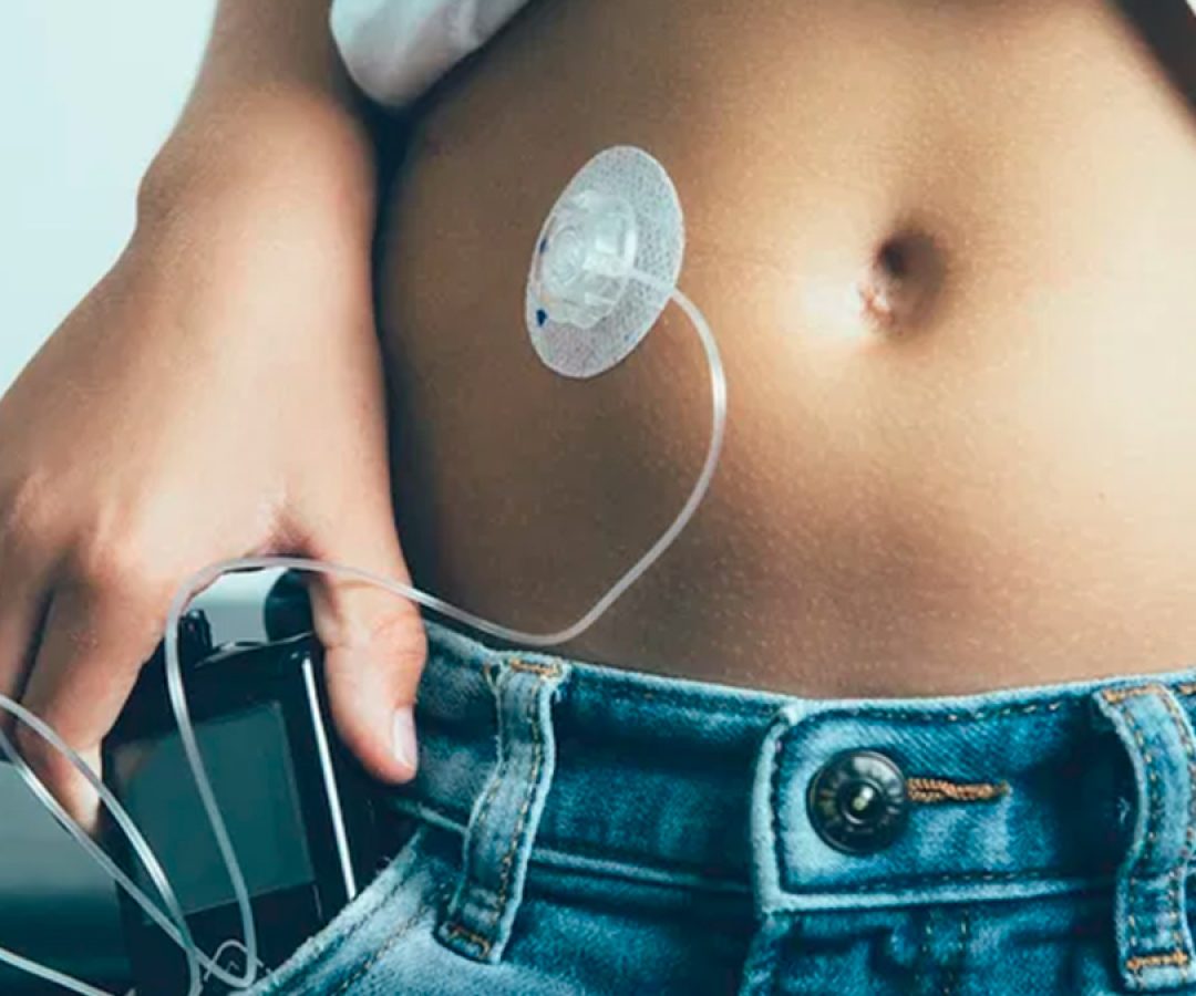 ilha-news-justica-determina-bomba-de-insulina-diabetes-ilha-solteira