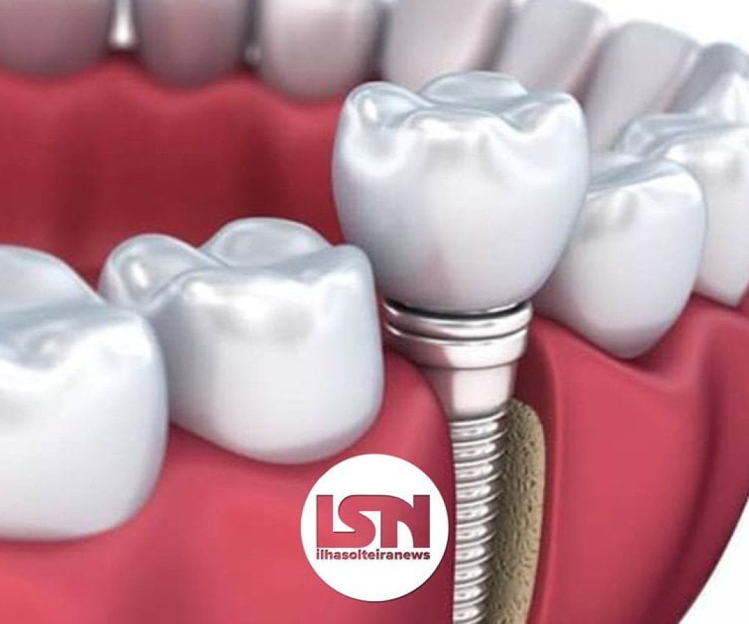 ilha-solteira-news-gou-odonto-implante-dentario