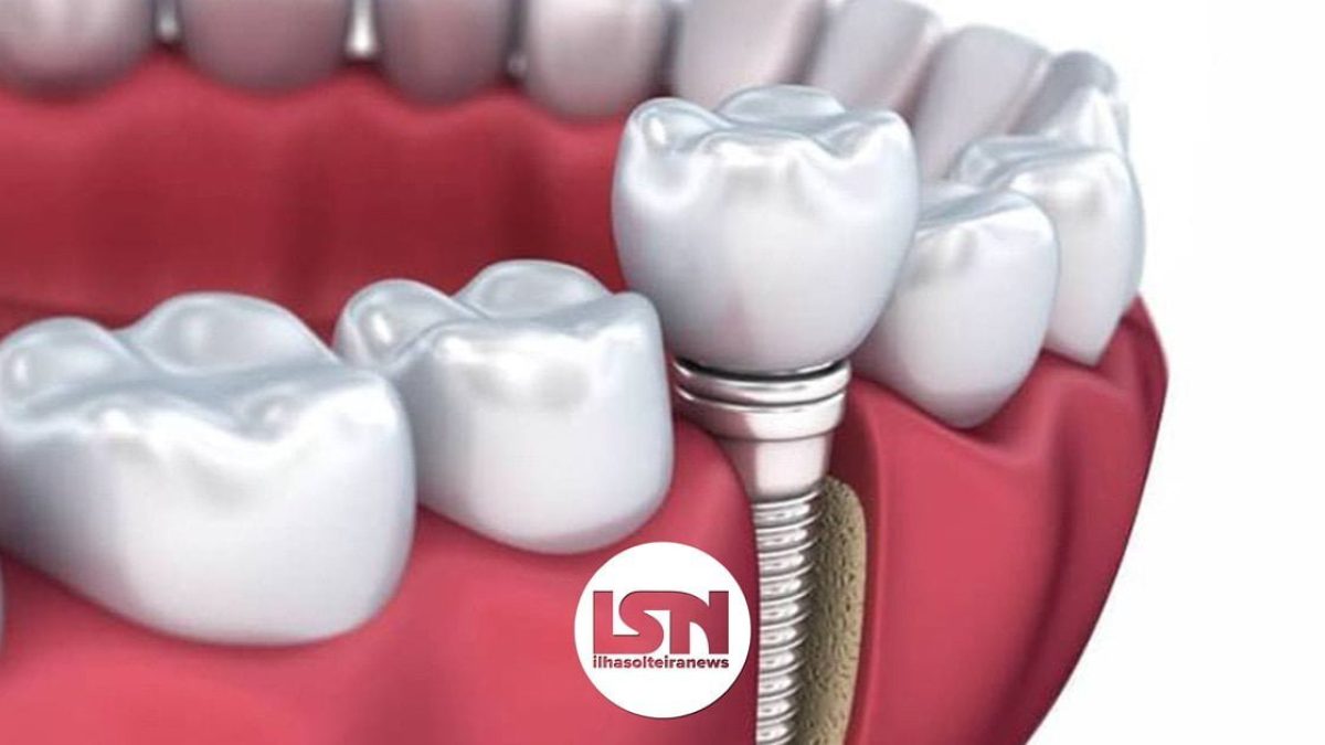 ilha-solteira-news-gou-odonto-implante-dentario