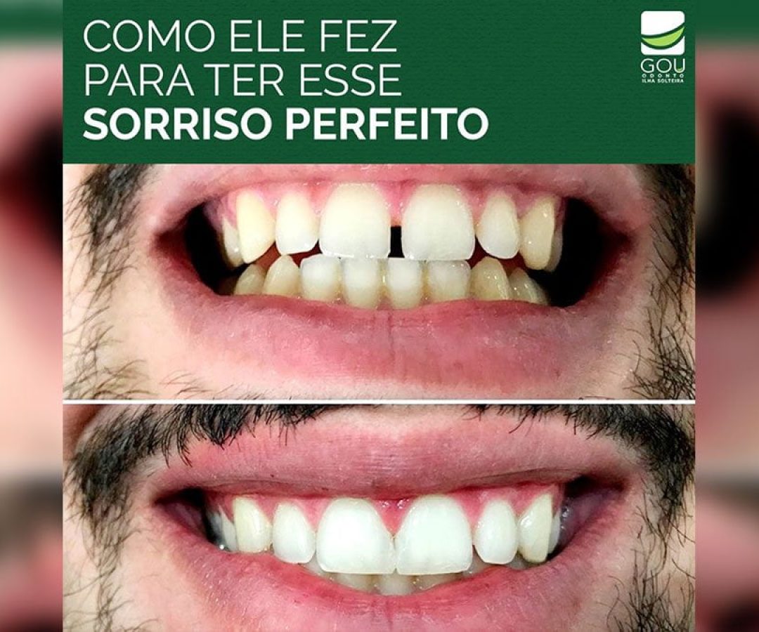 sorriso-perfeito-gou-odonto-ilha-solteira-news sorriso-perfeito-gou-odonto-ilha-solteira-news
