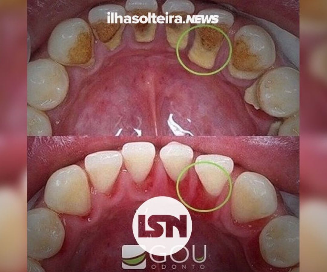 tartaro-gou-odonto-ilha-solteira-news