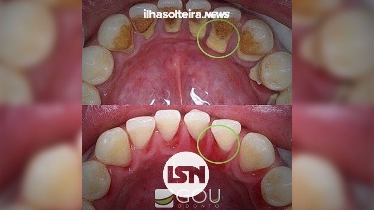 tartaro-gou-odonto-ilha-solteira-news